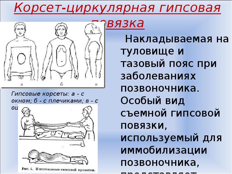 Гипсовые повязки презентация