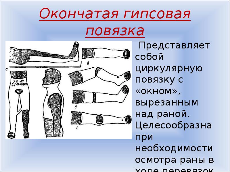 Гипсовые повязки презентация