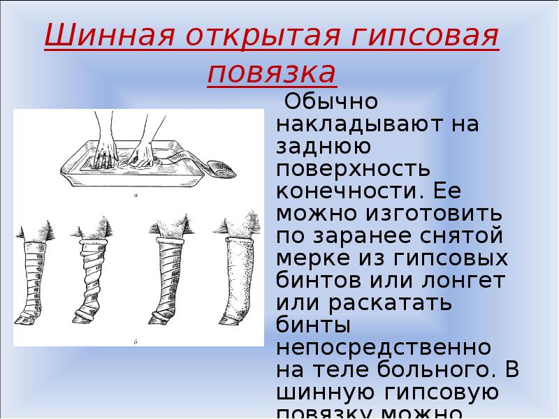 Первые гипсовые повязки