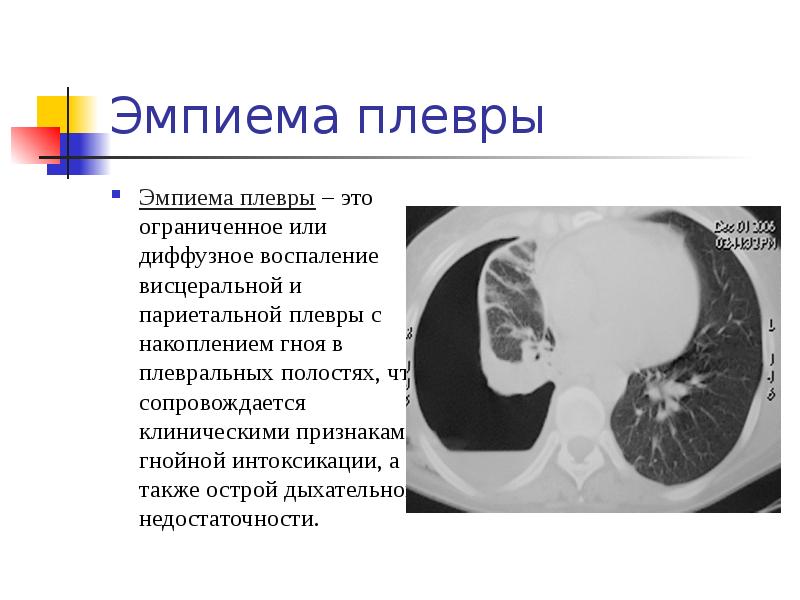 Эмпиема плевры презентация