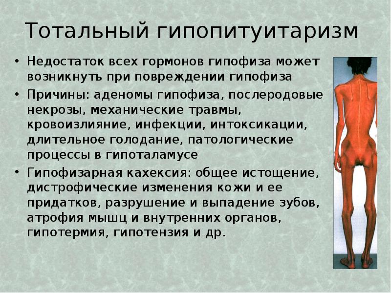 Кахексия что. Пангипопитуитаризм синдром Симмондса-шина. Послеродовой гипопитуитаризм (синдром Симмондса – Шихена). Тотальный гипопитуитаризм этиология патогенез проявления.