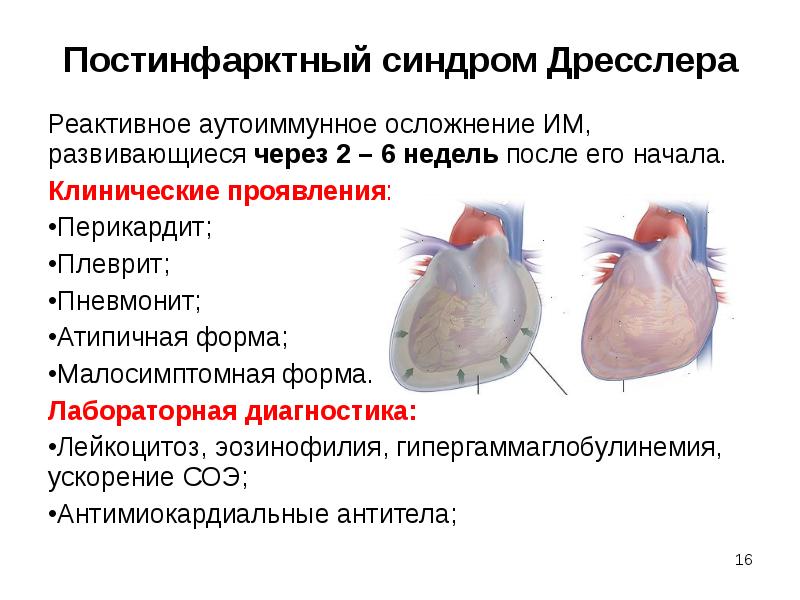 Осложнения при инфаркте миокарда презентация