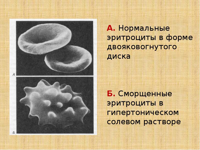 Нормальные эритроциты. Эритроциты форма двояковогнутого диска. Сморщенные эритроциты. Нормальный эритроцит. Слипшиеся эритроциты.