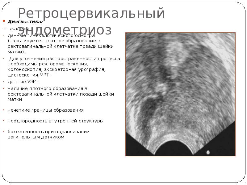 Ретроцервикальный эндометриоз Диагностика:  -  жалобы  данные гинекологического осмотра