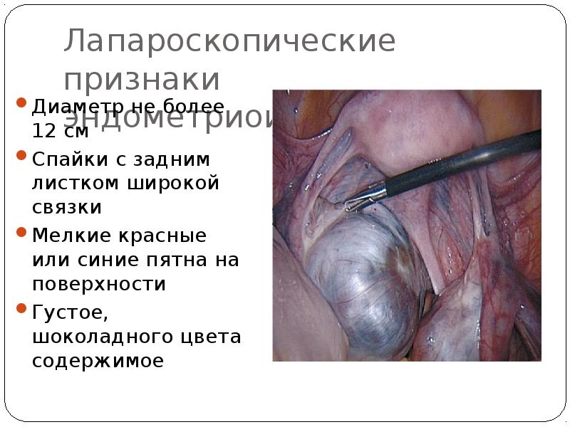 Лапароскопические признаки эндометриоидных кист Диаметр не более 12 см Спайки с