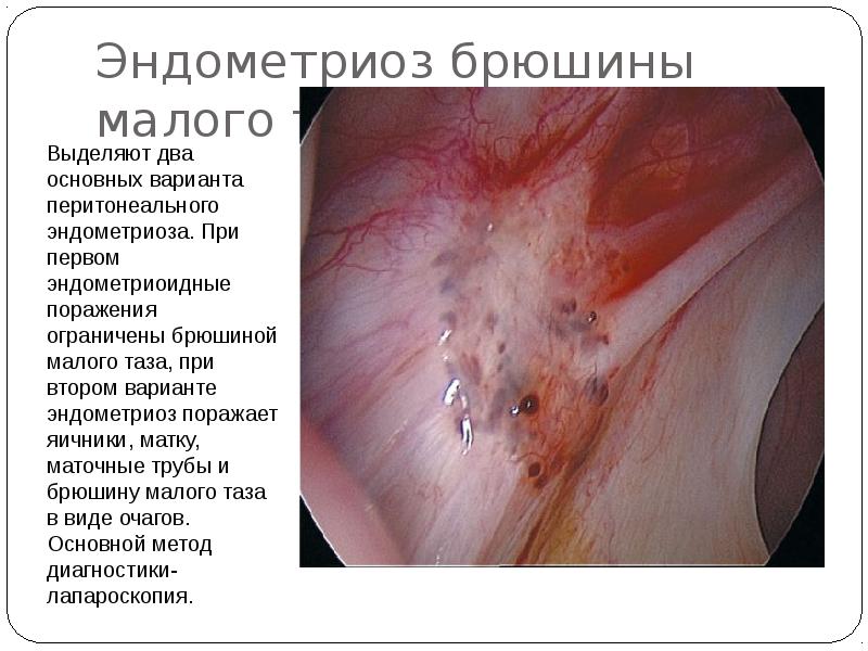 Эндометриоз брюшины малого таза