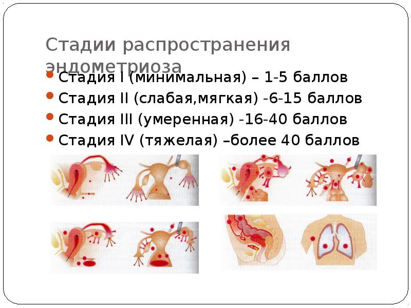 Стадии распространения эндометриоза  Стадия I (минимальная) – 1-5 баллов Стадия
