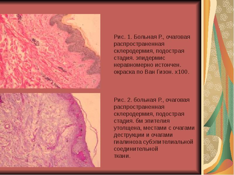 Системная склеродермия код