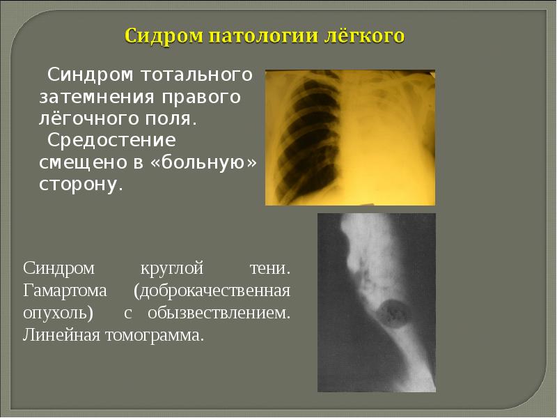 Рентгенологические синдромы заболеваний легких презентация