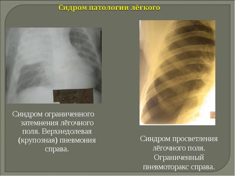 Рентгенологические синдромы заболеваний легких презентация