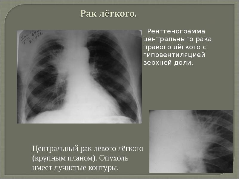 Рентгенологические синдромы заболеваний легких презентация