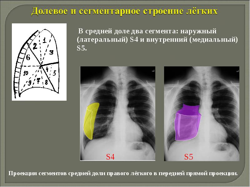 Рентгенологические синдромы заболеваний легких презентация