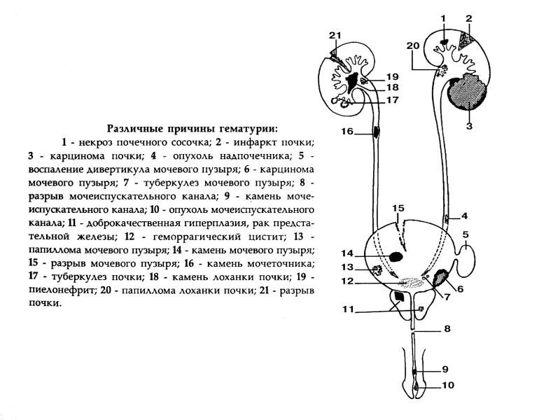 Почечная колика карта смп