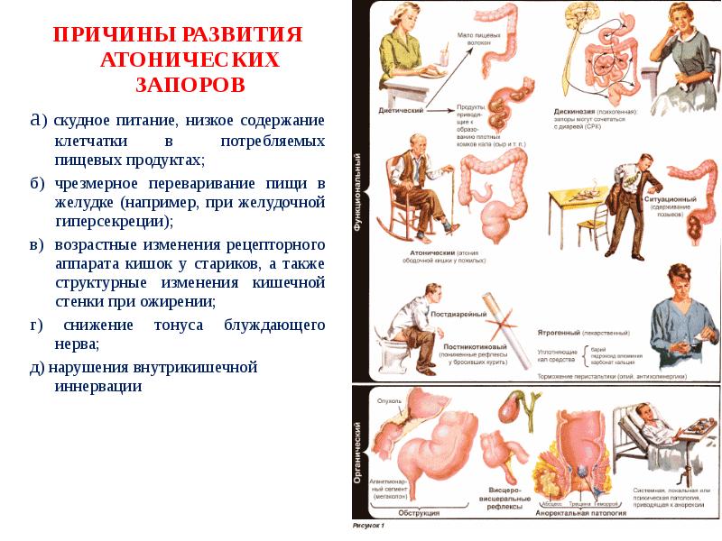 Спастический запор лечение