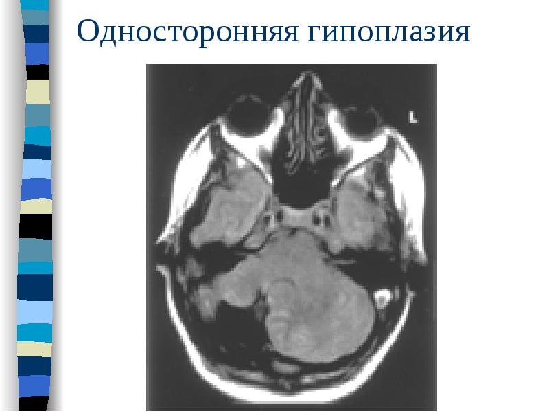 Односторонняя гипоплазия Односторонняя гипоплазия