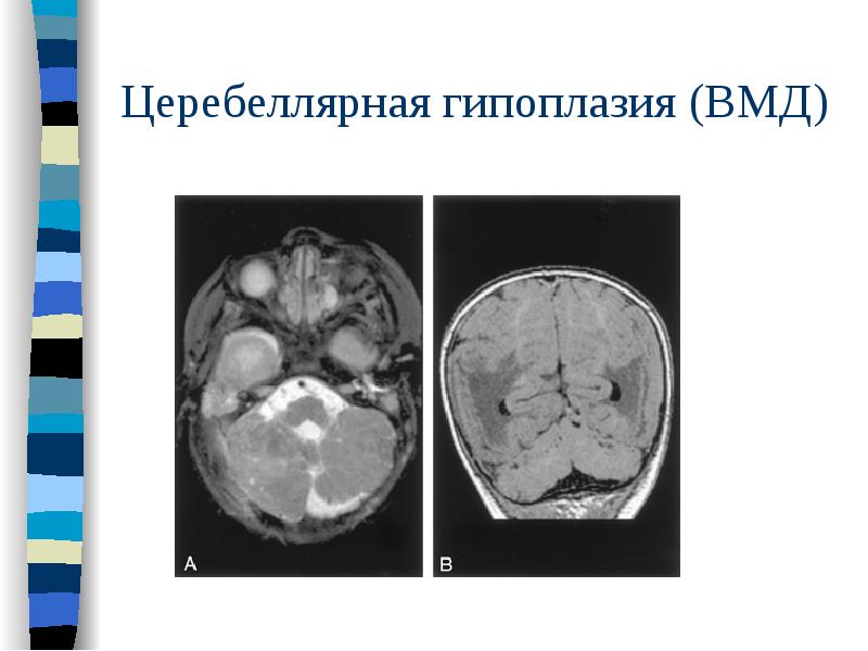 Церебеллярная гипоплазия (ВМД) Церебеллярная гипоплазия (ВМД)