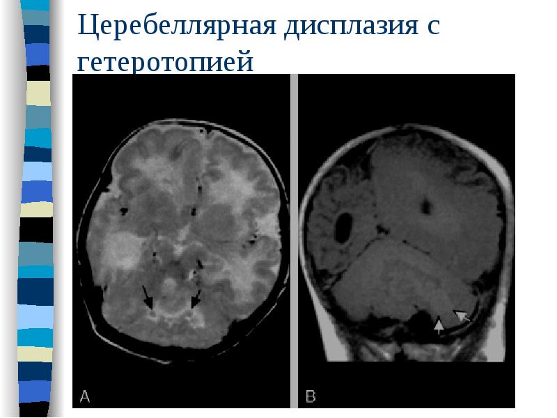 Церебеллярная дисплазия с гетеротопией Церебеллярная дисплазия с гетеротопией