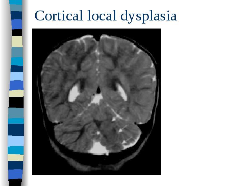 Cortical local dysplasia Cortical local dysplasia