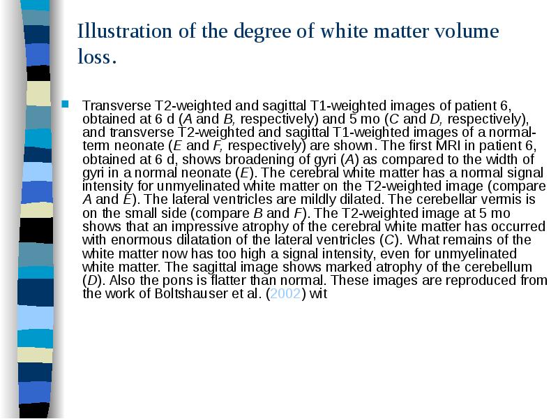 Illustration of the degree of white matter volume loss.
Transverse T2-weighted Illustration of the degree of white matter volume loss.
Transverse T2-weighted