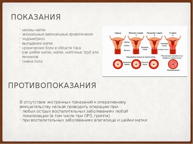 Презентация экстирпация матки