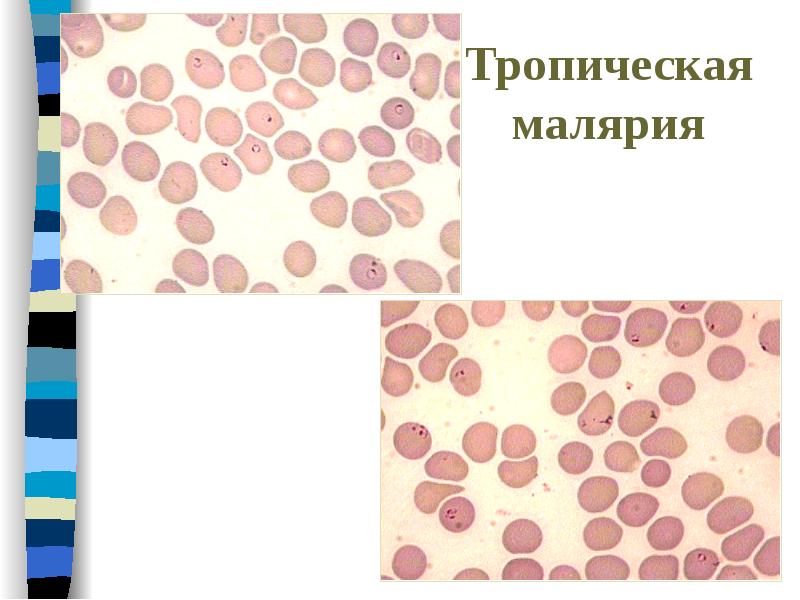 Малярия картина крови