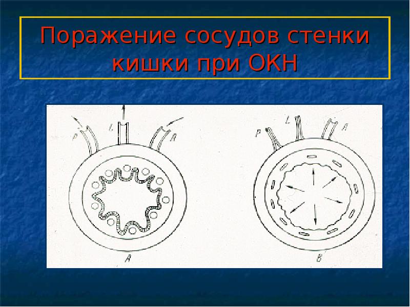 Кишечная непроходимость презентация на эту тему