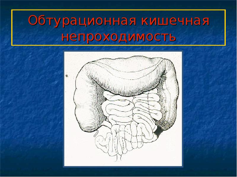 Кишечная непроходимость презентация на эту тему