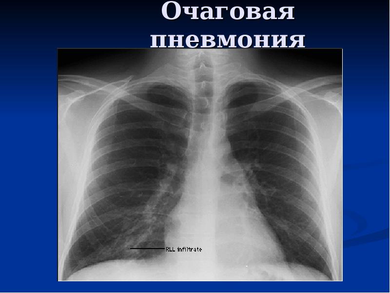 Презентация по внебольничной пневмонии скачать