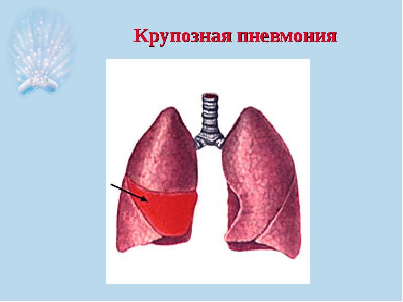 Крупозная пневмония презентация