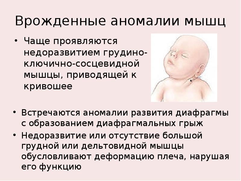 Аномалии развития. Внутриутробные пороки развития. Пороки развития мышечной системы.