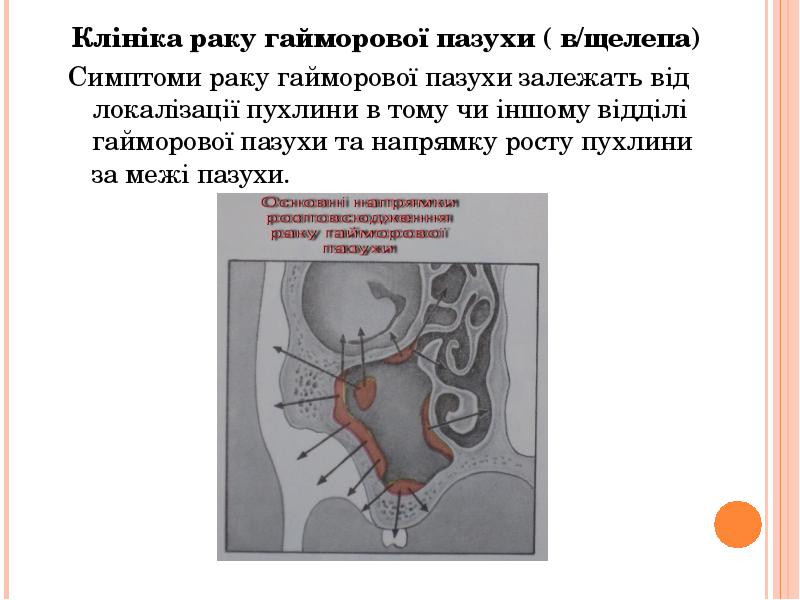 Клініка раку гайморової пазухи ( в/щелепа)
Клініка раку гайморової пазухи ( Клініка раку гайморової пазухи ( в/щелепа)
Клініка раку гайморової пазухи (