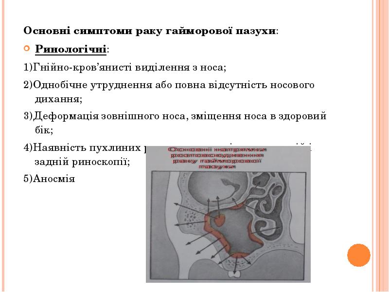 Основні симптоми раку гайморової пазухи:
Основні симптоми раку гайморової пазухи:
Ринологічні: Основні симптоми раку гайморової пазухи:
Основні симптоми раку гайморової пазухи:
Ринологічні: