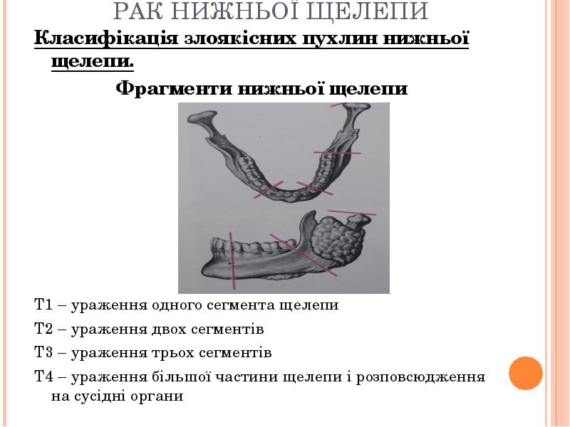 РАК НИЖНЬОЇ ЩЕЛЕПИ
Класифікація злоякісних пухлин нижньої щелепи.
Фрагменти нижньої щелепи
РАК НИЖНЬОЇ ЩЕЛЕПИ
Класифікація злоякісних пухлин нижньої щелепи.
Фрагменти нижньої щелепи