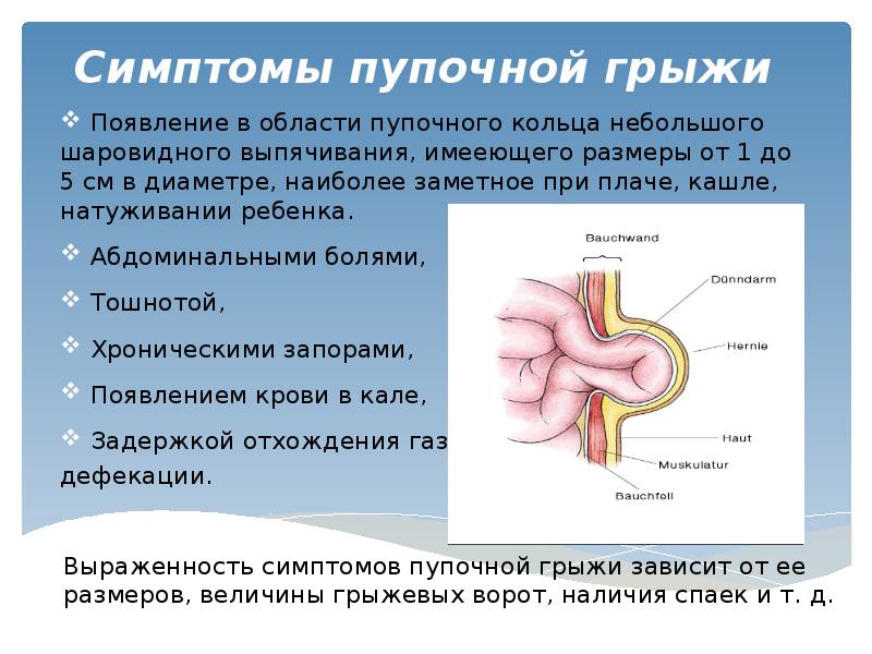 Пупочная грыжа симптомы фото