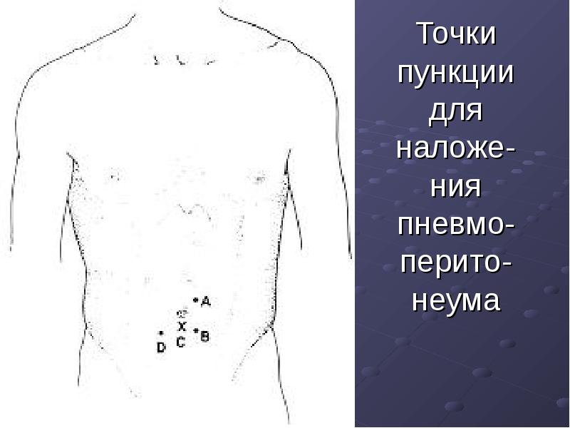 Точки пункции для наложе-ния пневмо-перито-неума