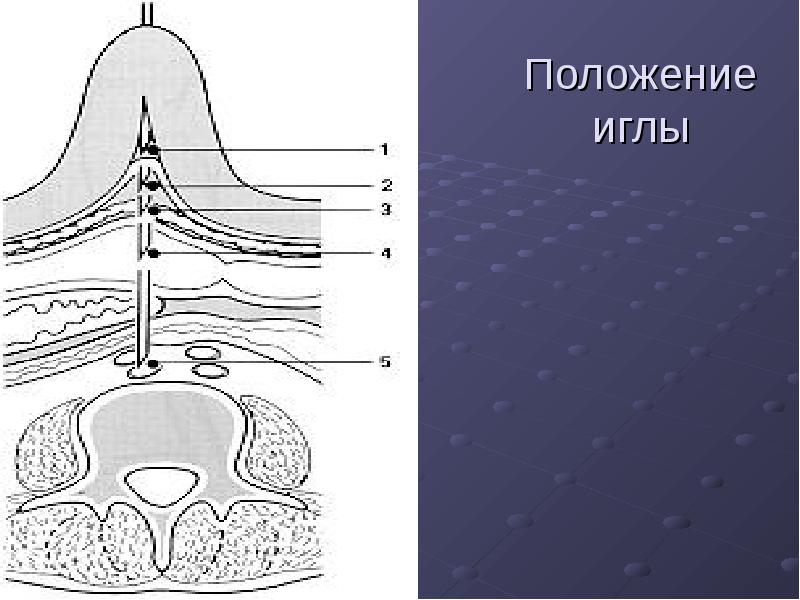 Положение иглы