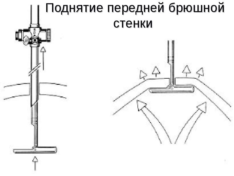 Поднятие передней брюшной стенки