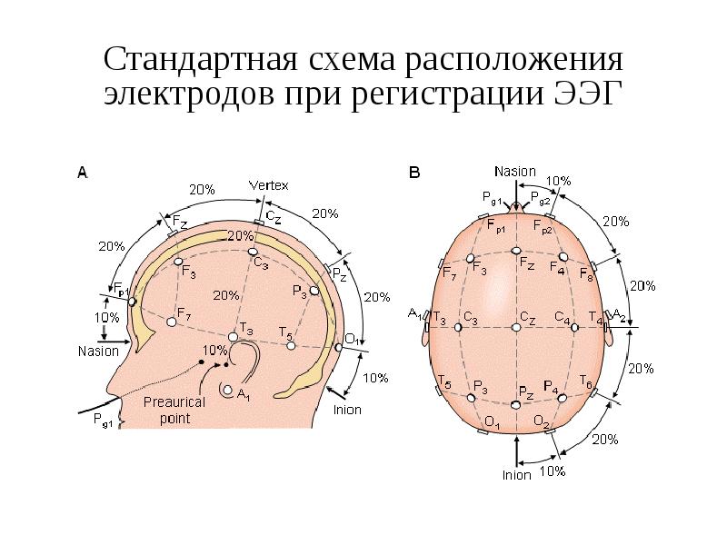 Схема наложения электродов при ээг рисунок памятка