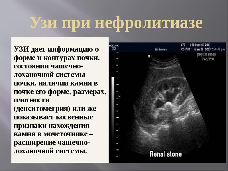 Нефролиты. Нефролитиаз УЗИ. Нефролитиаз почек УЗИ. Почечнокаменной болезни УЗИ. Камни в почках на УЗИ.