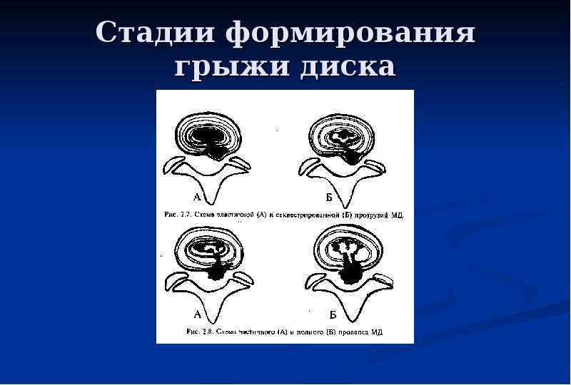 Презентация по неврологии остеохондроз