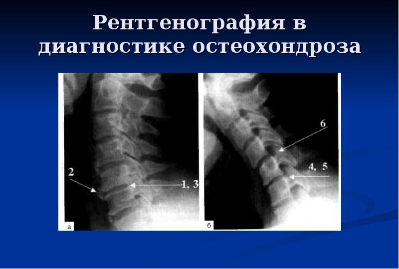 Презентация по неврологии остеохондроз