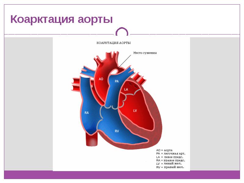 Комбинированные пороки сердца у детей презентация