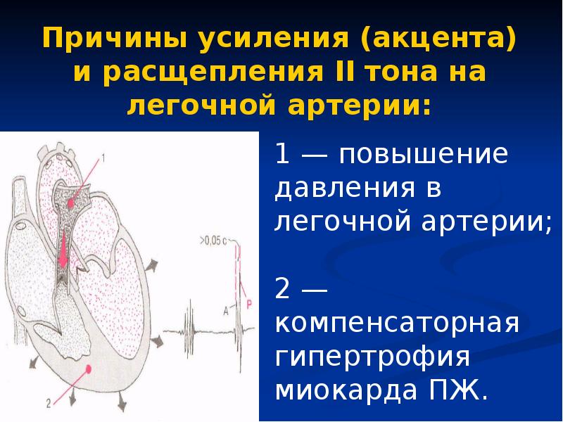 Тоны сердца акцент 2 тона