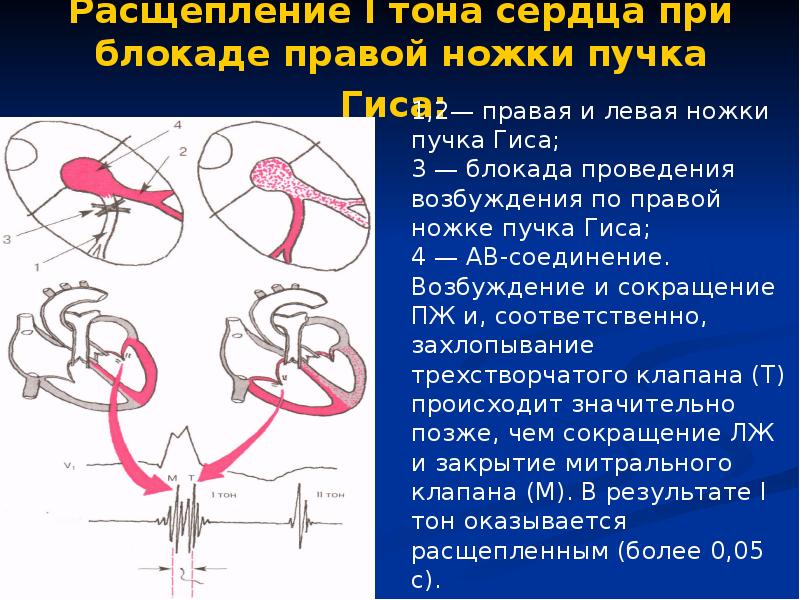 Третий тон сердца