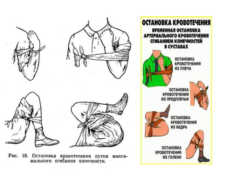 Рисунок остановка кровотечения