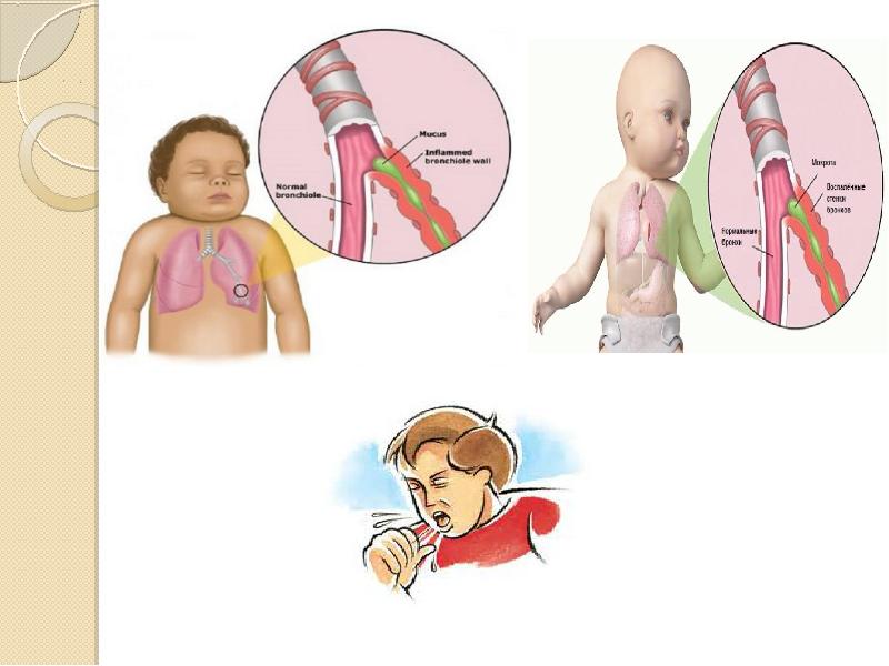 Балалардағы бронх демікпесі презентация