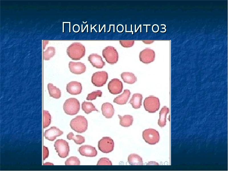 Пойкилоцитоз анемия. Пойкилоцитоз анизоцитоз анемия. Анизоцитоз и пойкилоцитоз. Пойкилоцитоз при железодефицитной анемии. Жда анизоцитоз пойкилоцитоз.