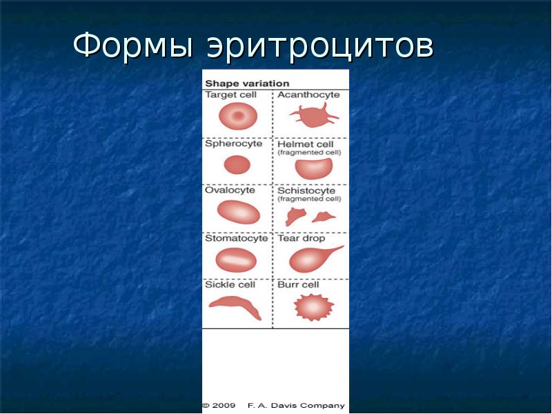 Эритроциты форма. Аномалий морфологии эритроцитов таблица. Патологические формы эритроцитов. Формы эритроцитов при анемии. Изменение морфологии эритроцитов при анемиях.