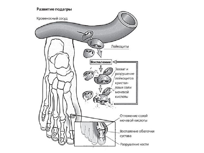Подагра патогенез. Механизм развития подагры схема. Патогенез подагры схема. Патогенез подагры схема биохимия. Этиология подагры схема.