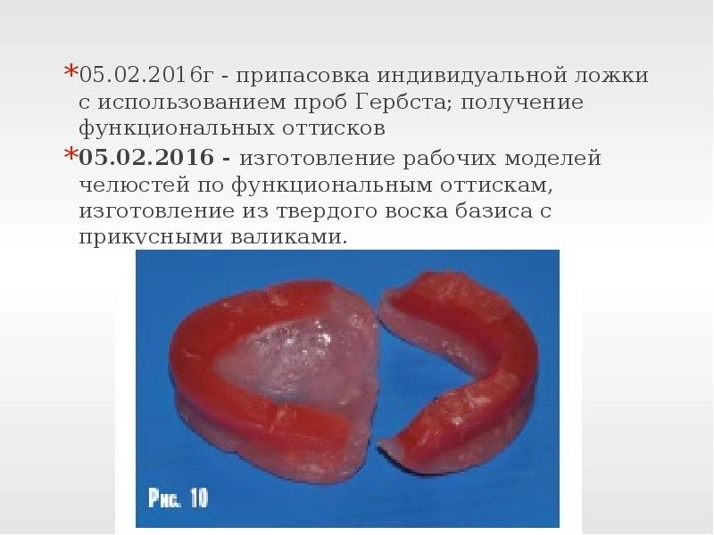 Индивидуальные ложки в ортопедической стоматологии презентация